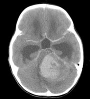 Researchers have recently found that childhood medulloblastomas have many fewer mutations than different adult cancers.