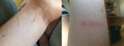 These are the injuries Joan said were left on Thrin's arms after her contact with Dr. Mireille Miller-Young